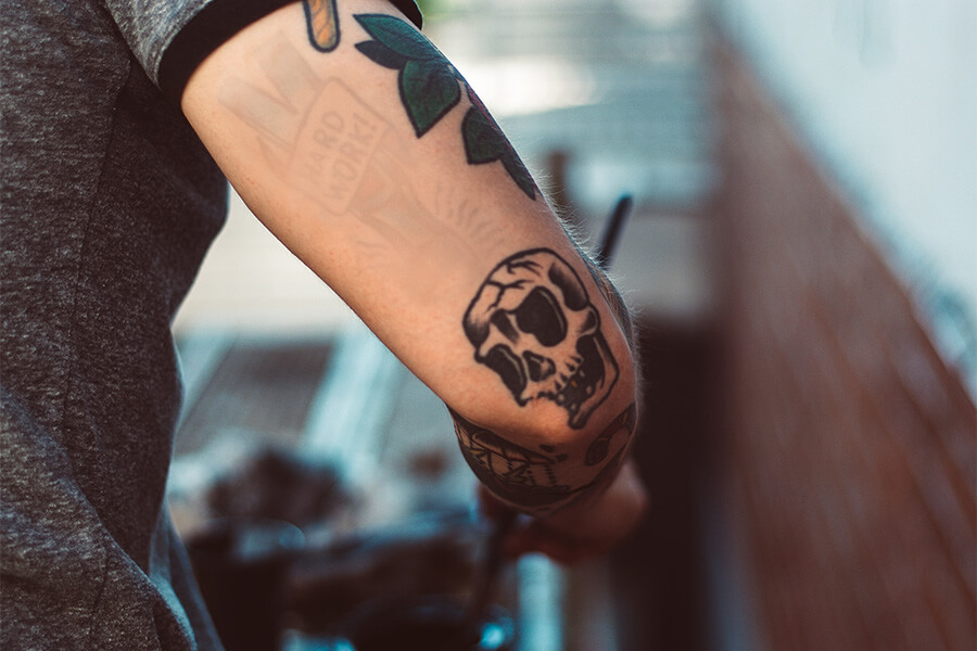 remocao-de-tatuagem