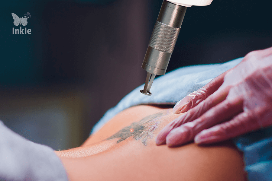 Inkie Laser-A solução definitiva para remoção de tatuagem e lesões pigmentadas