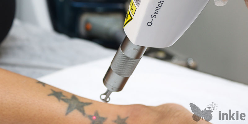 Mulher realizando procedimento para remover tatuagem no tornozelo