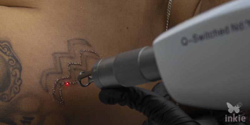 Foco na ponteira do Inkie realizando a remoção de tatuagem a laser