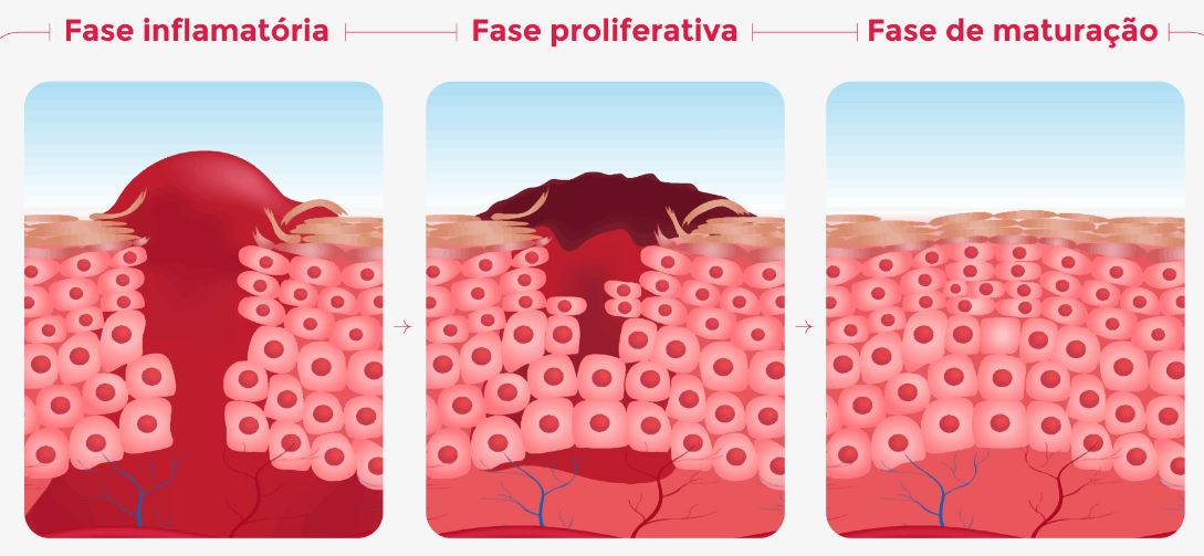 Imagem ilustrando as fases da cicatrização da pele