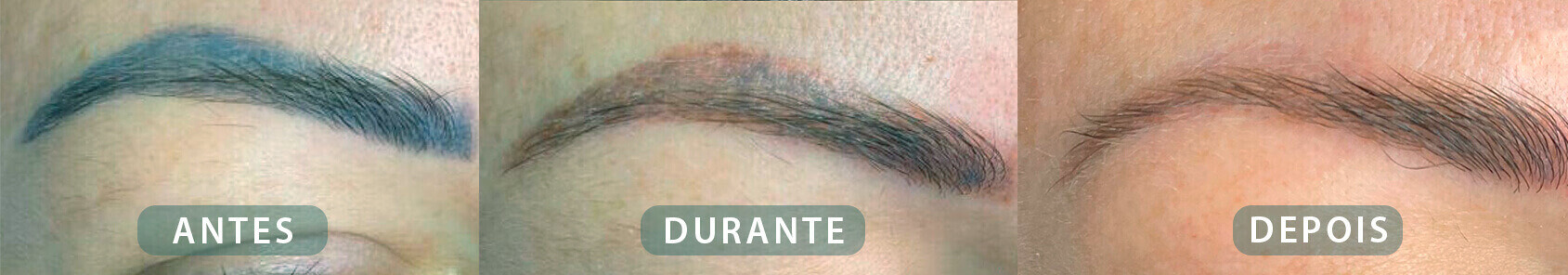 Antes e depois do procedimento de remoção de micropigmentação a laser