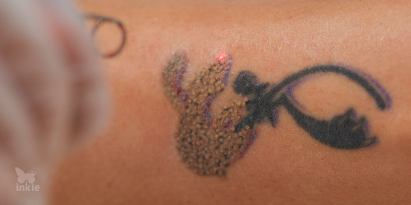 Processo de remoção de tatuagem