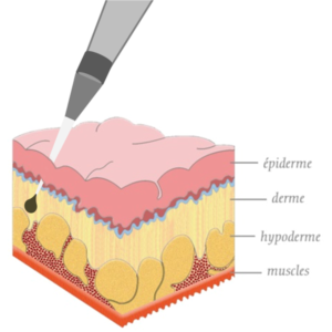 Esquema de aplicação de tatuagem na pele