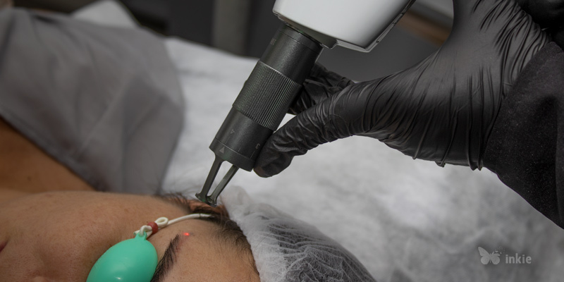 Mulher deitada fazendo sessão de laser para remoção de micropigmentação