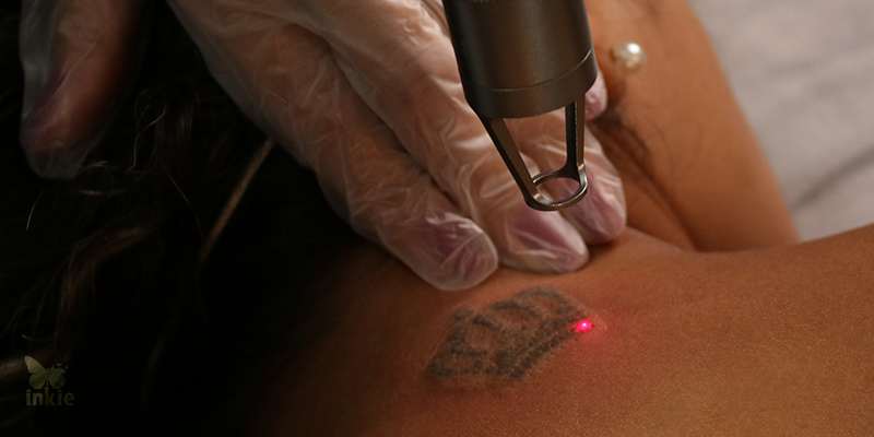 Profissional realizando sessão de laser para remoção de tatuagem na nuca do paciente