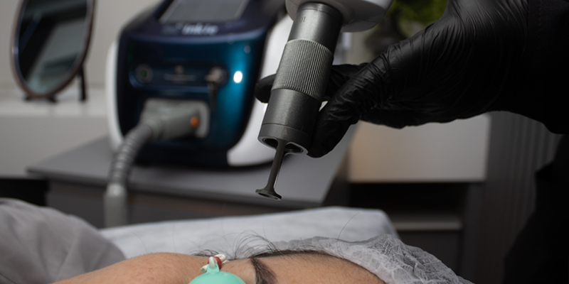 Profissional fazendo a aplicação do Inkie, um laser Q-Switched Nd Yag para despigmentação a laser