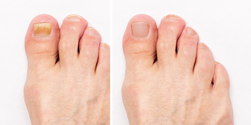 Unha do pé com onicomicose e após tratamento com laser.