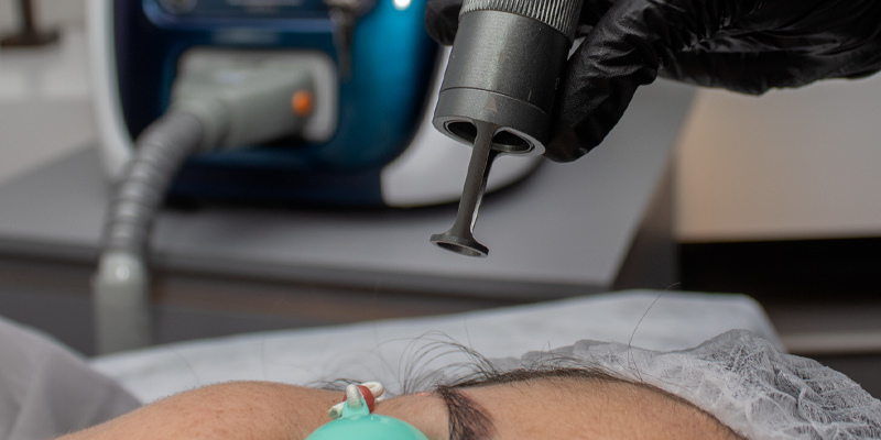 Aplicação com Inkie Laser Despigmentação de sobrancelha a laser