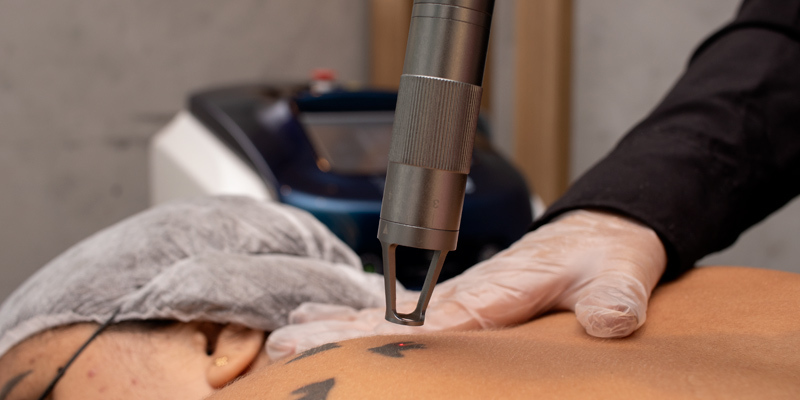 Mulher fazendo sessão de remoção de tattoo